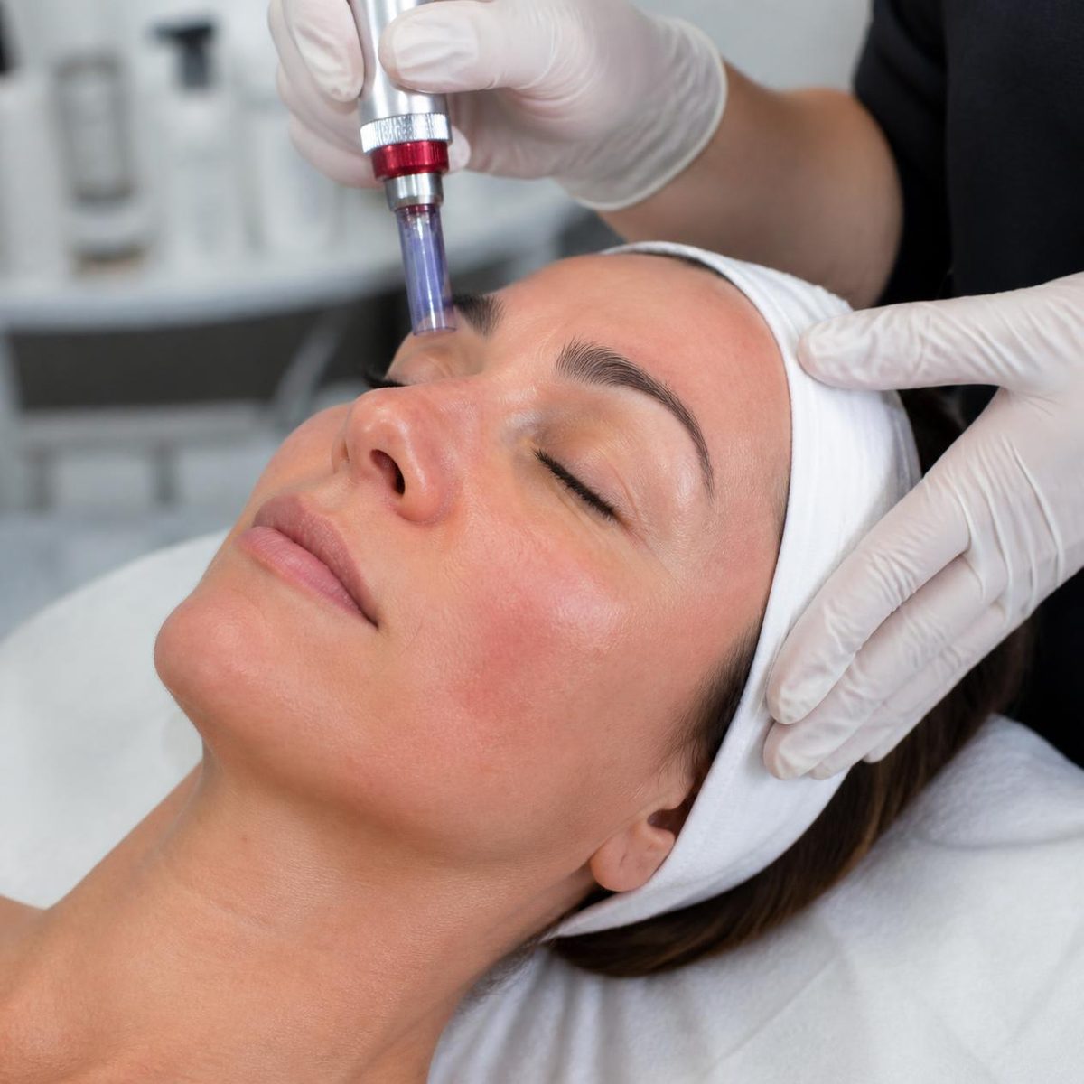 A microneedling pass across the cheek